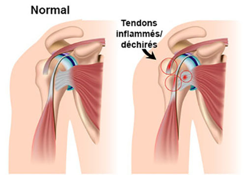 La tendinite